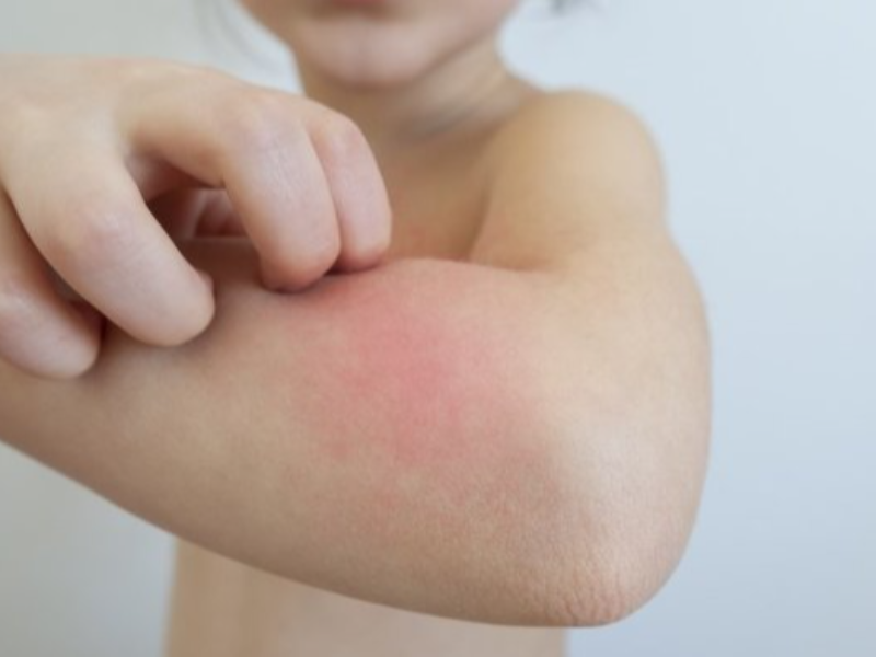 Atopik Dermatit (Egzama) Nedir?