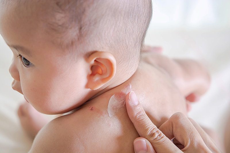 Besin Alerjileri İyileştikten Sonra Beslenme Alışkanlıkları