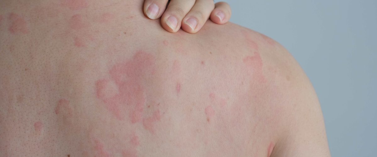Ürtiker Nedir?
